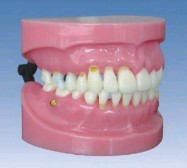 牙周病演示模型YR-L1022